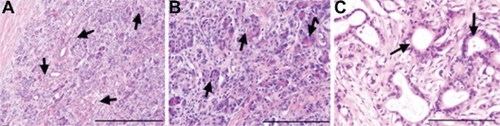 Figure 5 Preserved tumoral architecture after laser treatment or HSA-MWCNT administration. A) Before irradiation/administration: tumoral structures infiltrating between normal pancreatic acini (black arrows) H&E stain, obx100, (scale bar represents 400 μm). B) After irradiation: normal pancreatic acini with chromatic polarity and infiltrating tumoral structures (black arrows) H&E stain, obx200 (scale bar represents 400 μm). C) After HSA-MWCNT administration: normal tumoral duct structures lined by a single layer of polymorphic columnar cells surrounded by the desmoplastic stromal reaction (black arrows) H&E stain, obx200 (scale bar represents 200 μm). Results are representative of three experiments.Abbreviations: H&E, hematoxylin and eosin stain; HSA, human serum albumin; MWCNT, multiwalled carbon nanotubes.