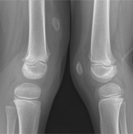 Figure 1. The left and right knee prior to operation.