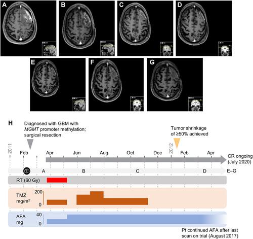 Figure 1 Radiological Disease Assessment in Patient 1. (A) March 2011: Scan taken at entry (baseline) for trial 1200.38. Treatment with afatinib (20 mg QD), RT (60 Gy in 30 fractions over 6 weeks) and TMZ (75 mg/m2 QD) commenced in the same month. From 06 May 2011, the patient received afatinib (40 mg QD) monotherapy for approximately 4 weeks. The patient then began six cycles of afatinib (40 mg QD) with TMZ (100–200 mg/m2 for Days 1–5 of each 28-day cycle) on May 31, 2011. (B) June 2011: Scan taken during Cycle 1, after 10 weeks of treatment with afatinib ± TMZ. (C) October 2011: Scan taken during Cycle 5 of 6 with afatinib with TMZ QD (Days 1–5 per cycle). The patient then received afatinib monotherapy from November 2011. (D) March 2012: Scan taken during Cycle 10, after approximately one year of treatment. Tumor shrinkage ≥ 50% was achieved in January 2012 and maintained beyond March 2015. (E) April 2013 (Cycle 24). (F) March 2014 (Cycle 36). (G) March 2015 (Cycle 48). Patient continued afatinib monotherapy as part of a Named Patient Use program after August 2017. As of July 2020, the patient was well and continued to show a complete response based on local neurological review. (H) Timeline of treatment and response. Horizontal dark gray arrow represents time on treatment before disease progression. The dates of the scans shown in panels (A-G) are illustrated on the light gray horizontal arrow, which is labelled with the black, circular scan icon.