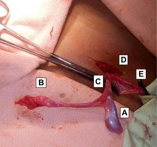 Figure 1 Left type 3 triorchidism with common vas and separate epididymis. A. cranial testis, B. Caudal testis, C. common vas D. inguinal incision E. Hernia sac.