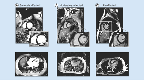 Figure 2.  Identification of myocardial fibrosis using late gadolinium enhancement. (A) A boy with Duchenne muscular dystrophy and strong cardiac involvement; (B) a moderately affected boy with moderate cardiac involvement and (C) a healthy volunteer with no signs of fibrosis.