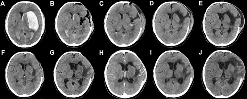 Figure 1 Brain CT after admission in patient with intracranial CRPK infection. (A) Before craniotomy on Apr 18. (B) After craniotomy on Apr 19. (C) After craniotomy on Apr 21, subdural effusion can be seen. (D) After craniotomy on Apr 24, a small amount of subdural effusion appeared. (E) After craniotomy on May 10, Subdural Effusion has developed significantly. (F) After cerebrospinal fluid leakage and intracranial infection on May 14, subcutaneous drainage tube was inserted, subdural Effusion decrease. (G) After cerebrospinal fluid leakage and intracranial infection on May 17, Subdural Effusion disappear. (H) enhanced CTbrain scanning showed no brain abscess on May 17. (I) After the treatment of anti-infective regimen on May 24. (J) After the treatment of anti-infective regimen on May 30, Ventricular Dilatation was observed.