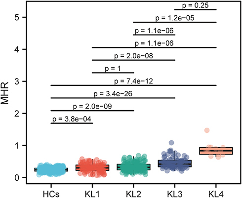 Figure 3 Monocyte-to-high density lipoprotein-cholesterol ratio in osteoarthritis patients with different Kellgren and Lawrence scores.