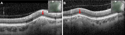 Figure 4 OCT imaging of representative SCC lesions in the right eye (left eye not shown) near the (A) superior and (B) inferior retinal arcades. The sclera appears to have a “rocky-rolling” surface with thinning of overlying choroid.