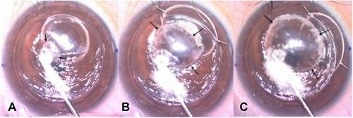 Figure 2 Incomplete Type 1 big bubble formation without stromal whitening. (A) Central commencement of Type 1 bubble in a clear cornea (black arrows). (B and C) Enlargement of Type 1 bubble (black arrows) with AC bubble displacement to the periphery (white arrows).