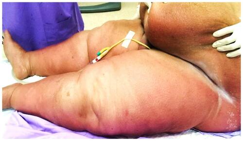 Figure 1 Acute inflammatory edema manifesting as erythematous, edematous plaques on the lower abdomen and dependent parts of the lower extremities with sparing of the skin folds.