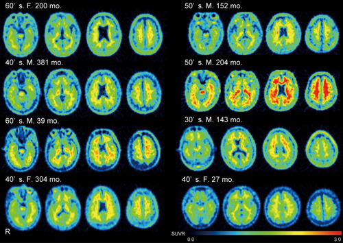 Figure 6 18F-FPYBF-2 PET images in all patients with diffuse axonal injury.18F-FPYBF-2 uptake was observed in cerebral gray and white matter in patients with diffuse axonal injury.