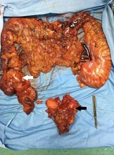 Figure 4 Surgical specimen following of total colectomy (the cecal mass was represented with white arrow) and total cystoprostatectomy (the specimen of prostate and bladder was highlighted with black arrow).
