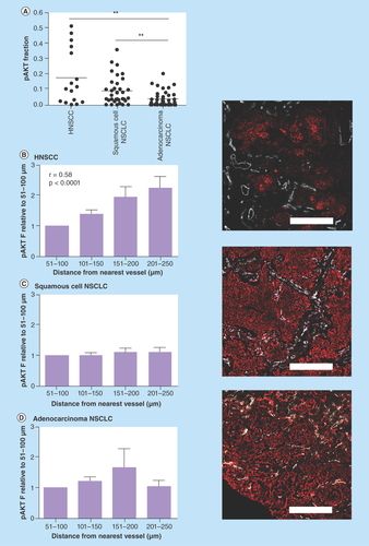 Figure 4.  Expression pattern of phosphorylation of AKT in patient biopsies from head and neck squamous cell carcinoma and non-small-cell lung cancer.(A) Tumor fraction positive for pAKT in HNSCC and NSCLC patient biopsies. (B) Expression of pAKT in relation to vessels in biopsies from HNSCC; (C) squamous cell carcinoma NSCLC and (D) adenocarcinoma NSCLC patient tumors. pAKT fraction is depicted relative to the fraction observed within 51–100 μm zone from the nearest vessel. Zone within 50 μm from the vessels was excluded due to low amount of tumor cells (mostly stromal components). Microscopic images: pAKT (red), vessels (white). Magnification: 100×, scale bars represent 500 μm.HNSCC: Head and neck squamous cell carcinoma; pAKT: Phosphorylation of AKT.**p < 0.01.