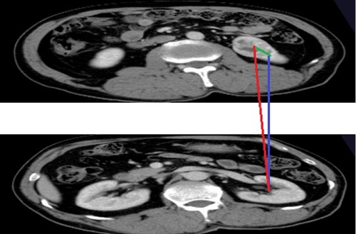 Figure 1 CI score. Distance y (blue line) between middle axial plane and plane of maximum tumor diameter is calculated by multiplying the number of sections by thickness of the section. Distance x (green line) is measured from the central 90-degree axial reference point to the tumor center. Distance c (red line) is calculated and divided by tumor radius to determine CI.
