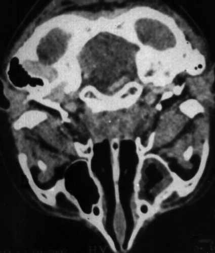 Figure 2.  Nasopharyngeal tomography of case 4 seven months after the cessation of therapy.