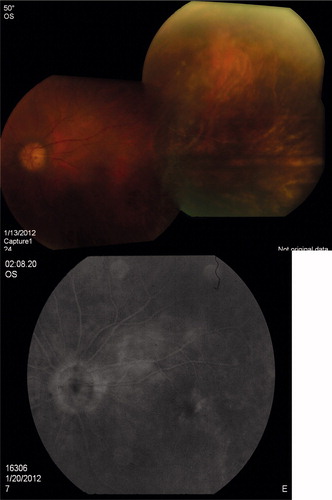 Figure 4. (A) Color fundus photo: clear vitreous and absorption of intraretinal hemorrhage. (B) FA OS: no vasculitis or optic disc staining in the late phase.