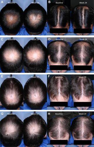 Figure 5 Representative pre- (baseline) and posttreatment (week 24) photographs of subjects with androgenetic alopecia treated twice daily with setipiprant tablets 1000 mg (2×500 mg for a daily total dose of 2000 mg) for 24 weeks. Photographs show the vertex and frontal/superior views of a 41-year-old subject (A and B), a 32-year-old subject (C and D), a 39-year-old subject (E and F), and a 37-year-old subject (G and H).