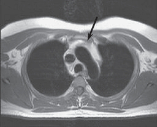 Figure 2 Axial T1 weighted image of the thymus of an antiretroviral treated hazardous drinker. The mediastinum largely consists of high intensity fat, with a small thymus (black arrow).