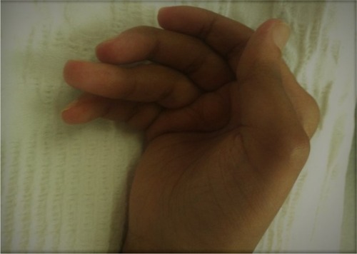Figure 1 Rheumatoid arthritis of the hand with deformity.