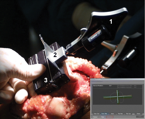 Figure 3. Conventional cutting block for the femur after navigated positioning. 1 = tracker; 2 = resection plane probe; 3 = 4-in-1 cutting block (Scorpio®). Inset is a screenshot from the navigation system showing the internal/external rotational alignment of the cutting block. [Color version available online.]