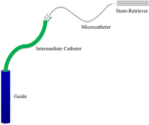 Figure 1. Schematic representation of the catheter sequence with guide, intermediate catheter, microcatheter and stent retriever.