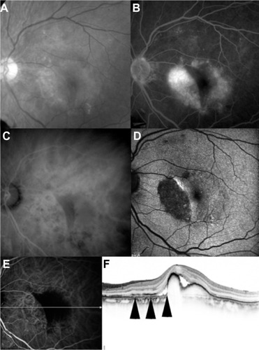 Figure 2 A month after the first intravitreal aflibercept injection. The best-corrected visual acuity was 20/28. (A) Red-free photograph showing an area of retinal pigment epithelium defect inferior to the fovea. (B) Fluorescein angiography image showing an area of hypofluorescence. (C) Late-phase indocyanine green angiography showing hypofluorescence. (D) Fundus autofluorescence showing an area of hypo autofluorescence. (E) Early-phase indocyanine green angiography and horizontal optical coherence tomography image. (F) Scanned by the white arrow on the left indocyanine green angiography image, which was simultaneously obtained by spectral-domain optical coherence tomography, showing defect of the retinal pigment epithelium line (arrows).