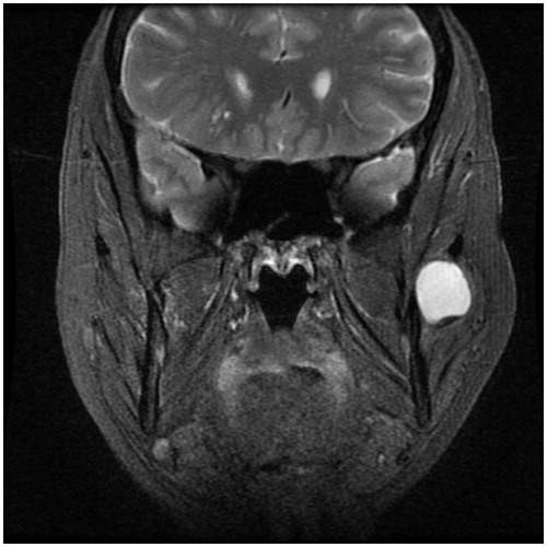 Figure 3. Coronal T2-WI showing a well-circumscribed hyperintense lesion lying deep to the masseter muscle, at the level of the mandibular notch.