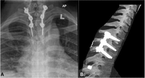 Figure 3 Post-operative AP (A) and lateral (B) radiograph shows a good alignment of the spinal column following posterior pedicle screw fixation.