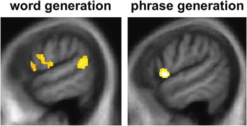 Figure 2. Statistical parametric maps (SPMs) showing regional gray matter atrophy significantly associated with task performance for sentence completion using an unconstrained word (left) or a phrase (right) in the combined patient cohort. SPMs are thresholded at p < 0.05 after small volume correction for multiple voxel-wise comparisons in pre-specified small anatomical volumes of interest and displayed on sagittal sections of the left hemisphere from a group mean T1-weighted MR brain template image in Montreal Neurological Institute standard space.