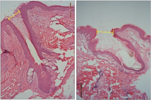 Figure 2 Pictures of hair follicles found in untreated skin (left) and e-roller treated skin (right). (Hematoxylin–eosin stain, at 10×.)