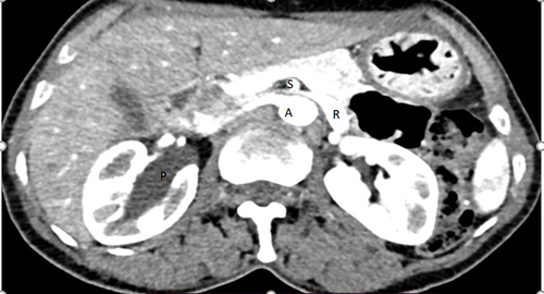 Figure 1 Cross-sectional image of patient showed left renal vein (R) compressed between SMA (S) and aorta (A) with dilatation of left renal vein. Dilated right renal pelvis (p) can also be seen.