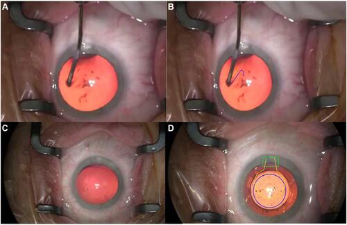 Figure 1 (A) Native picture of continuous curvilinear circular capsulotomy with Descemet´s membrane; (B) preparation of both Descemet´s membrane (yellow line) and anterior capsule (purple line) during continuous curvilinear circular capsulotomy; (C) native picture after creation of complete capsulotomy; (D) microscopic photo after creation of complete capsulotomy. Purple line marks continuous curvilinear capsulotomy, yellow line marks descemetorhexis and green line clear corneal incision.