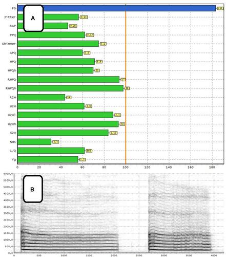 Figure 4 Voice acoustic analysis using Diagnoscope Specjalista by Diagnova Technologies; (A) collective analysis of acoustic parameters, (B) narrowband spectrography.
