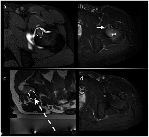 Figure 2. Intra-articular osteoblatoma of the femoral neck. (a) Transverse T1-weighted fat-suppressed MRI with intra-articular administration of Gd-contrast: the lesion is indicated by the dashed line. (b) Transverse T2-weighted fat-suppressed MRI. Note the edema around the lesion (@) and the intra-articular reactive fluid (arrow) less evident that in the previous case as showed in Figure 1 and in this figure. (c) Transverse T2-weighted MRI obtained during treatment: the # indicates the transducer that generates the ultrasound; the dashed arrow is the US pathway between the transducer and the lesion (dashed line). (d) Transverse T2-weighted fat-suppressed MRI during the follow up: complete disappearance of the bone edema and of the reactive intra-articular fluid.