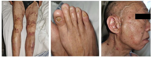 Figure 2. Other clinical features of junctional epidermolysis bullosa. (a) Erythematous patches covered by vesicles and bullae localized on the friction areas of lower limbs. (b) His toenails were dystrophic. (c) The patient suffered from alopecia.