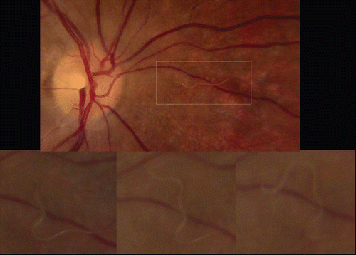 FIGURE 4  Fundus photographs, right eye. One week after initial presentation, a peri-papillary nematode is identified (top), and its movement through the subretinal space is observed (bottom).