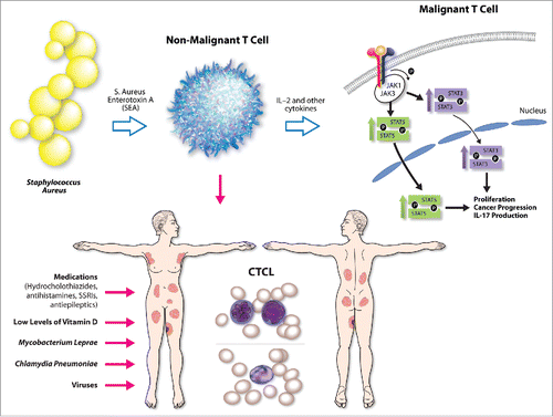 Figure 1. Summary of proposed potential etiologic triggers/promoters for CTCL include medications, viruses, low levels of vitamin D, Mycobacterium leprae, Chlamydia pneumonia, and Staphylococcus aureus. Recent evidence documents that S. Aureus enterotoxin type A (SEA) triggers non-malignant infiltrating T cells to release IL-2 and other cytokines that upon binging to their cognate receptors on malignant T cells are able to activate STAT3 and STAT5 oncogene signaling and promote cancer progression and IL-17 secretion.