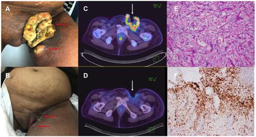 Figure 1 Clinical and Radiologic Response to pembrolizumab; Immunohistochemistry. (A and B) Clinical response to pembrolizumab; (A) Fungating left groin tumor and satellite nodule at baseline (September 2018), prior to starting pembrolizumab (horizontal red arrows); (B) Dramatic clinical response after 3 cycles of pembrolizumab in primary tumor and adjacent satellite nodule (December 2018) (horizontal red arrows). (C and D) Radiologic response to pembrolizumab; (C) Baseline PET-CT showing fungating and intensely FDG-avid mass (SUVmax 19.6) at the left groin (vertical white arrow) with invasion of the adductor compartment of the left thigh; (D) Follow-up PET-CT after 6 months showing marked reduction in size and metabolic uptake (SUVmax = 3.9) of the tumor (vertical white arrow). (E) Hematoxylin and eosin x20 stain confirming clear cell carcinoma: the tumor is composed of nests of cells with round nuclei, prominent nucleoli and ample clear to eosinophilic cytoplasm; (F) Immunohistochemistry for PD-L1 using the Dako 22C3 pharmDx assay, combined positive score of 45.