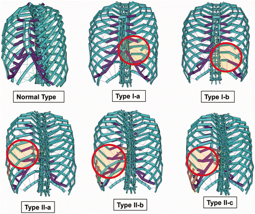 Figure 4. Examples of models representing each of the harvesting patterns. Costal cartilages or ribs are harvested from the regions indicated by circles. Types II-a, II-b, and II-c are viewed from behind.