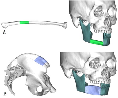 Figure 2. Mandible reconstructed with free fibula (A) or deep circumflex iliac artery (B) flap.