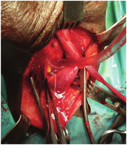 Figure 2. Excision of the strictured segment.