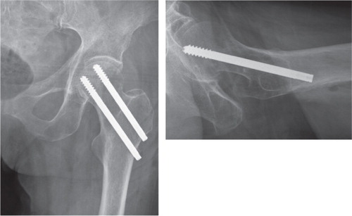 Figure 1. Internal fixation of a Garden I–II femoral neck fracture with 2 parallel cannulated screws.