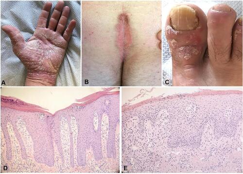 Figure 1 (A) Clinical manifestation of palmar psoriasis. (B) Clinical manifestation of sacral psoriasis. (C) Clinical manifestation of nail psoriasis. All the three clinical images report the difficult-to-treat areas, recognized as unmet needs by patients and physician. (D) Histopathological features of plaque psoriasis. The classic epidermal psoriasiform hyperplasia is associated with hyperparakeratosis and loss of granular layer. Collections of neutrophils are observed in the upper stratum spinosum (spongiosiform pustules of Kogoj). In the dermis, thin capillary vessels reach almost the top of the dermal papillae and are surrounded by a chronic lymphocytic infiltrate with sparse neutrophils (Haematoxylin-eosin. Original magnification: 100x). (E) Histopathological features of genital psoriasis. The classic features observed in plaque psoriasis are attenuated in the genital area. The epidermal hyperplasia is associated with less extensive hyperparakeratosis, which is accompanied by mounds of neutrophils in the stratum corneum (Munro’s microabscesses). In the chorion, thin capillary vessels are surrounded by a chronic lymphocytic infiltrate, with sparse neutrophils (Haematoxylin-eosin. Original magnification: 200x).