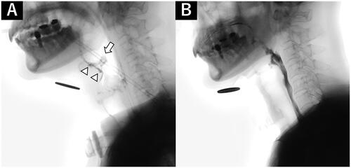 Figure 4. Videofluorography findings. (A) On POD 10, contrast agent passed through the perforation in the epiglottis and flowed into the larynx (arrowhead: contrast agent, arrow: tip of the epiglottis). (B) On POD 188, no aspiration was confirmed.