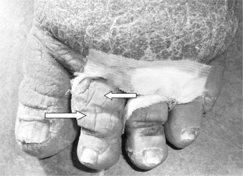 Figure 1 Characteristic changes (infiltration of lymph) within the second toe – a massive Stemmer’s sign.