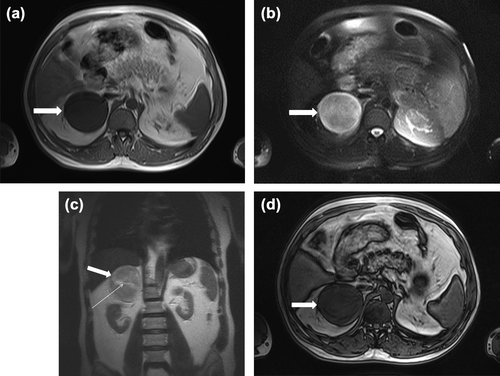 Figure 2. (a) Transverse T1-weighted magnetic resonance imaging (MRI) shows a round, slightly lobulated right adrenal mass that measures 8.5 × 7.5 × 7 cm (arrow). The mass is homogeneous, with signal intensity less than that of liver (hypointense). (b) Transverse T2-weighted MRI scan demonstrating round heterogeneous right adrenal mass (arrow) with markedly high signal intensity greater than that of liver (c) Coronal T2-weighted MRI scan demonstrating round heterogeneous right adrenal mass (thick arrow) with slightly high signal intensity greater than that of liver and with central crescent-shaped calcifications in adrenal mass (slightly hyperintensity) (thin arrow) (d) Out-of-phase MRI no showing significant signal loss in the lesion when compared with in-phase MRI (arrow).