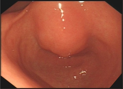 Figure 3 Gastroscopy showed chronic superficial gastritis and submucous eminent lesions in the lesser curvature of gastric antrum (size 3.5×2.5 cm).