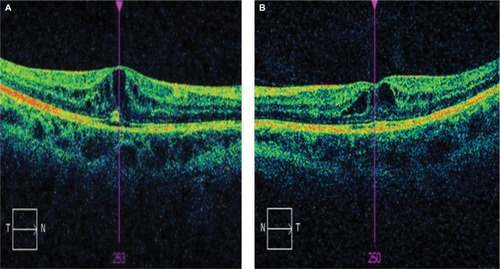 Figure 1 OCT macular images of right (A) and left (B) eyes in a patient treated with topiramate.