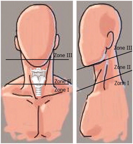Figure 7. Anatomical divisions of zones of the neck.