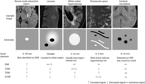 Figure 2 MRI findings related to small vessel disease illustrate examples (upper) and schematic representations (middle) of MRI features associated with such changes, accompanied by a summary of imaging characteristics (lower) specific to individual lesions. Increased signals are represented as ↑; Decreased signals are represented as ↓; Isointense signals are represented as ↔. MRI sequences included T2-fluid attenuation inversion recovery (T2-FLAIR), diffusion-weighted imaging (DWI), T1-weighted magnetic resonance imaging (T1WI), T2-weighted magnetic resonance imaging (T2WI), and susceptibility-weighted imaging (SWI).