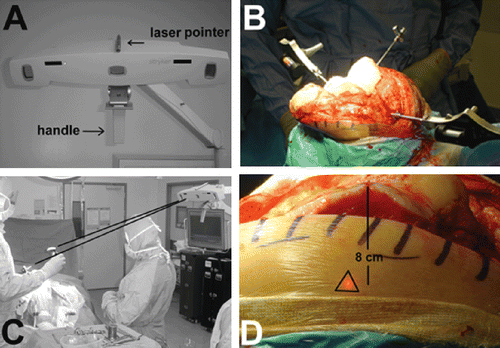 Figure 1. (A) The camera of the system with the laser pointer mounted on top. (B) The trackers fixed on the bone in a TKR operation. (C) The camera identifies the trackers. (D) The laser mark on the lateral femoral condyle approximately 8 cm below the surface of the articular cartilage. If the laser pointer aims in this area, the trackers will be immediately identified by the camera. [Color version available online.]