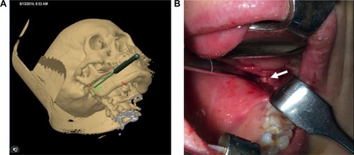 Figure 3 The intraoperative navigation was applied to expose the ESP by intraoral approach.