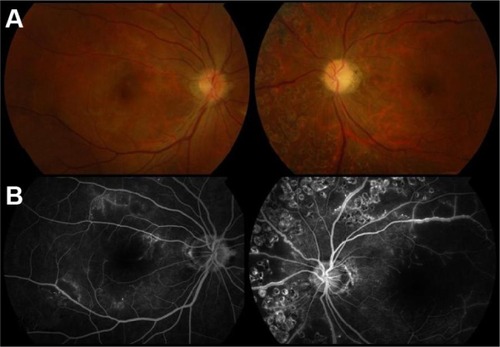 Figure 5 (A) There were no cotton-wool spots over posterior pole in either eye. The left disk seemed mildly waxy pale. (B) At the late phase in the macula, there was a smaller nonperfusion area in the right eye.