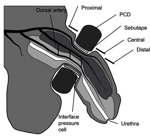 Figure 2 Location of the three measurements to assess the skin response on the penis when subjected to each of the penile compression devices (PCD) applied at their associated prescribed interface pressures.